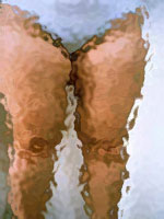 Лечение целлюлита в Торонто